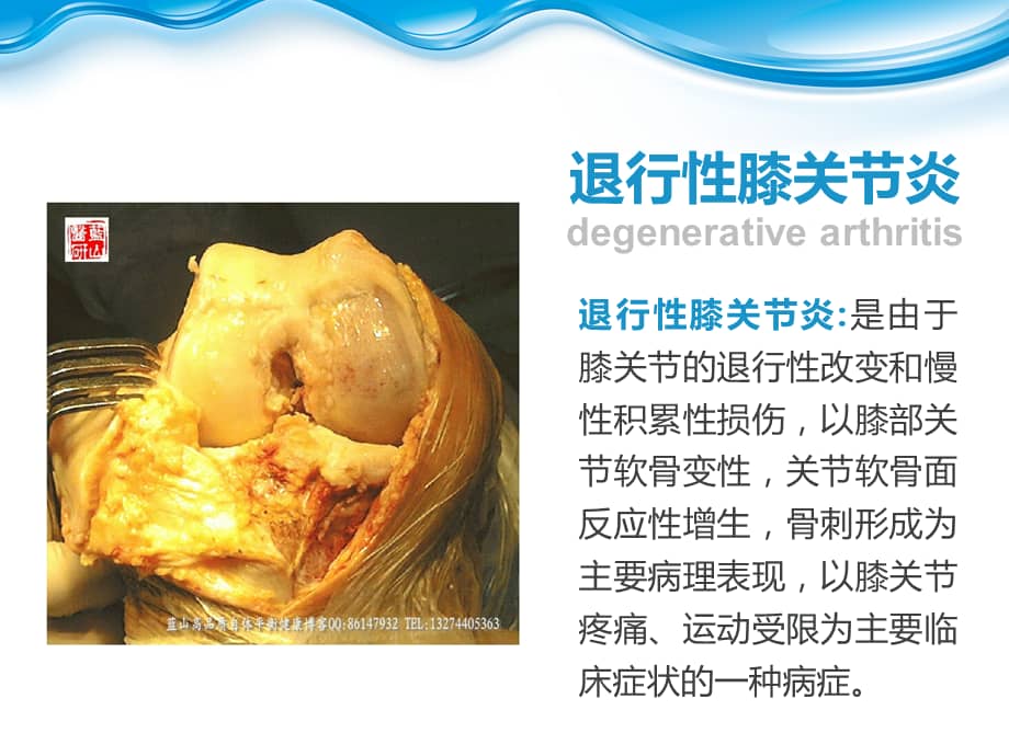 退行性膝关节病变ppt课件ppt