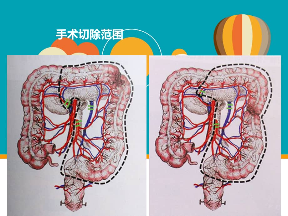 腹腔镜根治性(扩大)左半结肠切除术--ppt课件1.ppt_第3页