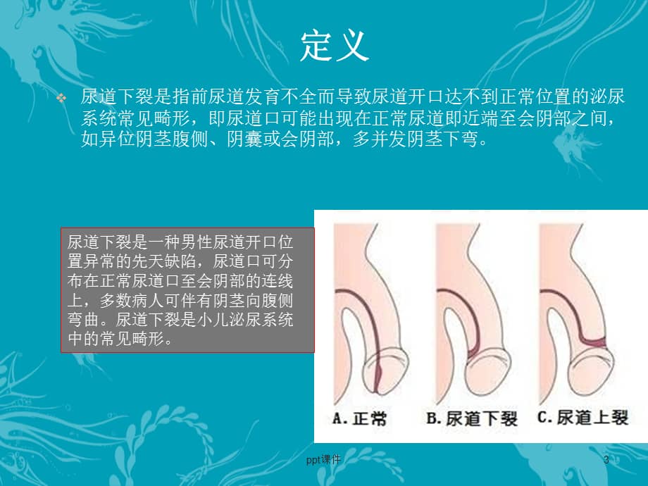 尿道下裂ppt课件ppt