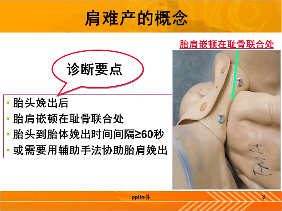 肩难产的处理ppt课件ppt