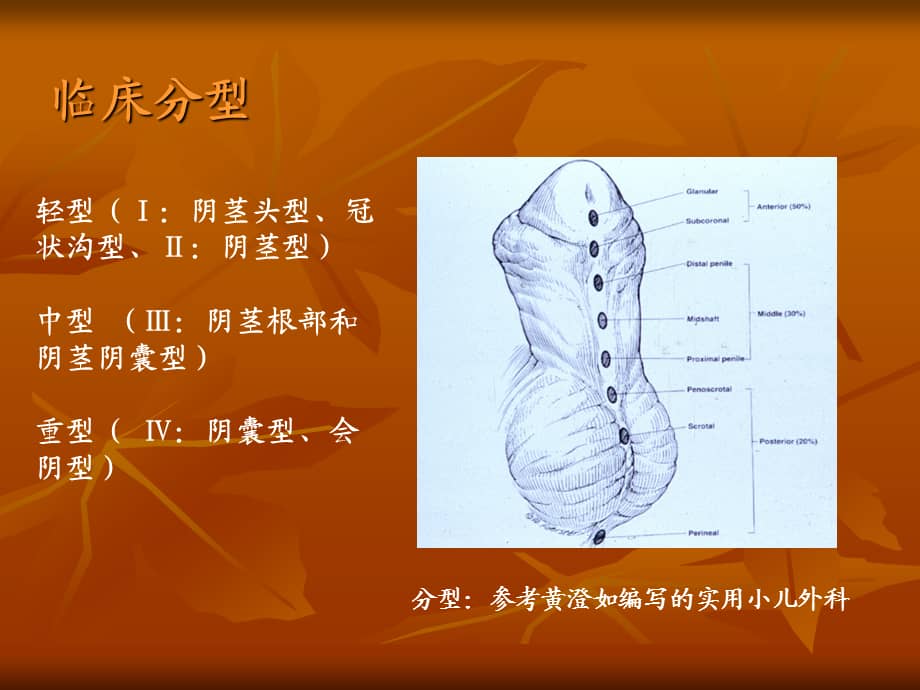 先天性尿道下裂课件.ppt_第3页